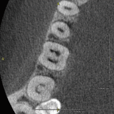 4根管の右下第一大臼歯　CT水平断面.gif